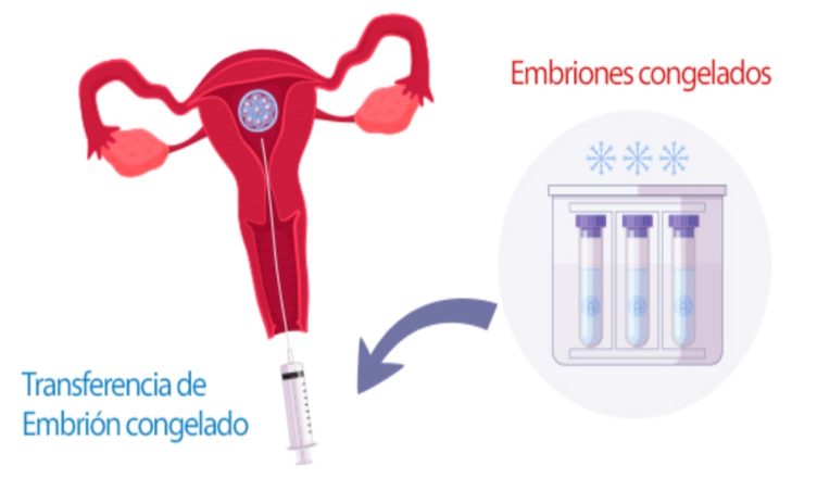 Transferencia de embrión congelado