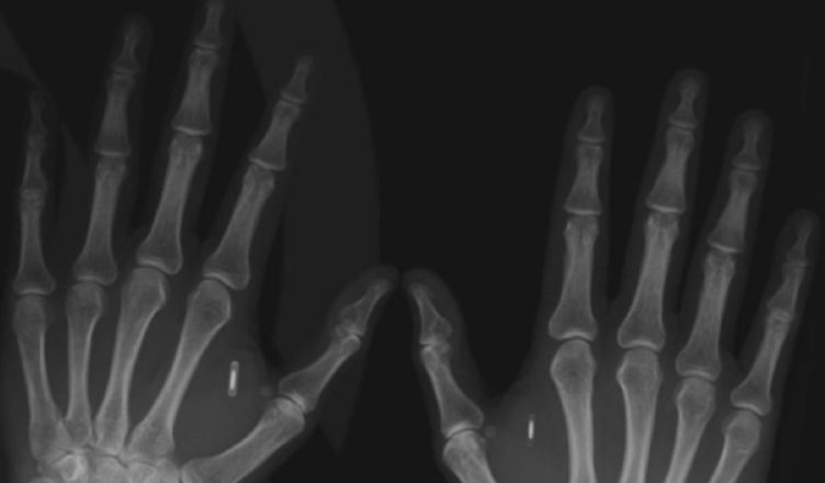 Microchip implantado en las manos